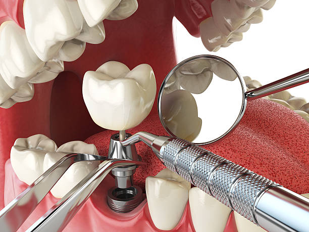 Best Emergency Tooth Extraction in Harvard, NE